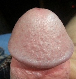 Photograph of an enlarged penis