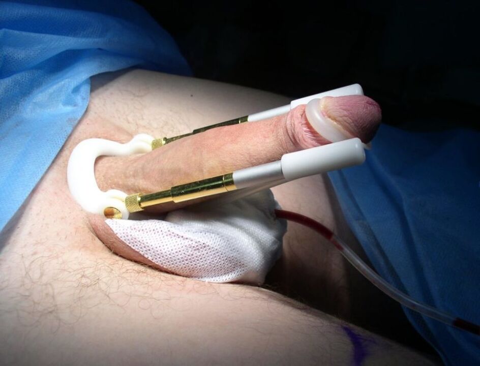 extender after penis enlargement surgery