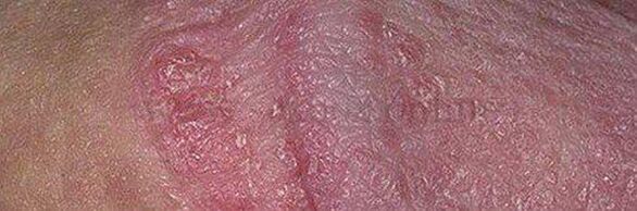 Dry skin and sores on the penis head after using baking soda