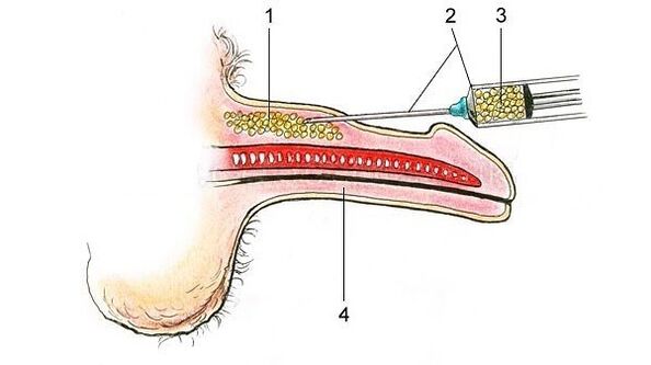 injection of hyaluronic acid to thicken the penis