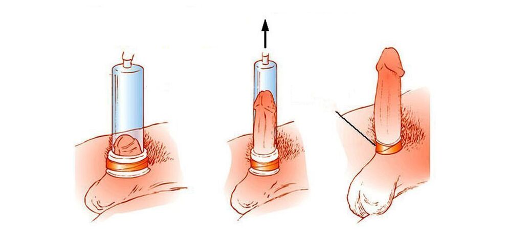 how a penis vacuum pump works